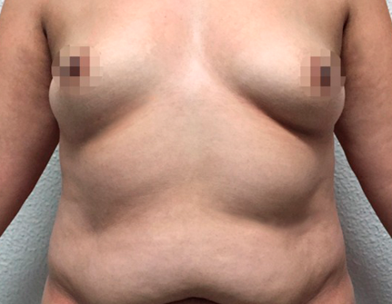 Before-Abdominoplastia + liposucción + implantes mamarios
